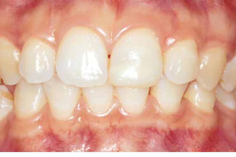 Bệnh nha chu không chỉ gây mất răng