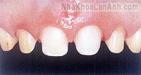 Các dạng điều chỉnh răng để phục hình răng giả
