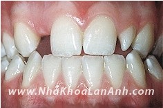 Trường hợp nào thì nên chỉnh nha?