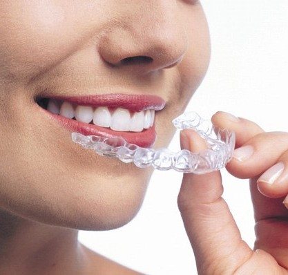 Niềng răng không mắc cài invisalign – Hình ảnh ca thực tế