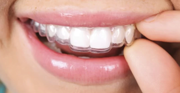 Giá niềng răng Invisalign bao nhiêu?