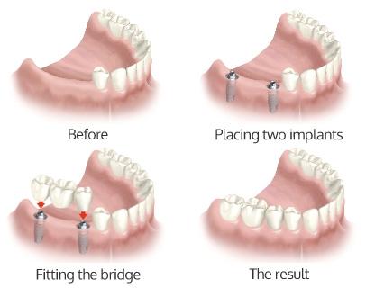 Các phương án trồng răng giả cố định