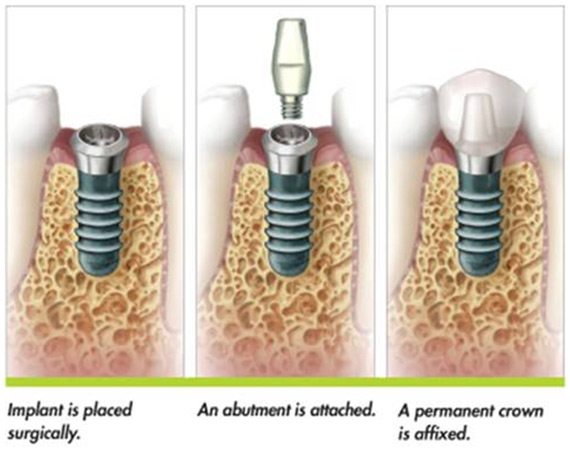 Trồng răng implant tại thành phố Hồ Chí Minh mất bao lâu?