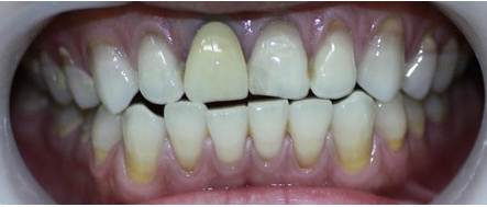 Khắc phục răng sứ bị đen viền nướu