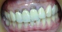 Răng sứ bị đổi màu và cách khắc phục