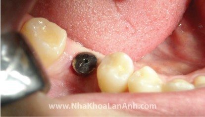 Điều gì giúp trồng răng implant thành công?