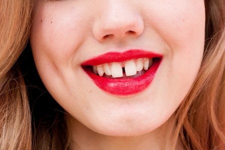 Răng cửa của tôi bị thưa. Tôi có thể làm răng sứ thẩm mỹ hoặc chỉnh hình răng được không?