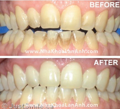 Tẩy trắng có thể làm răng tôi trắng sáng trở lại được không?