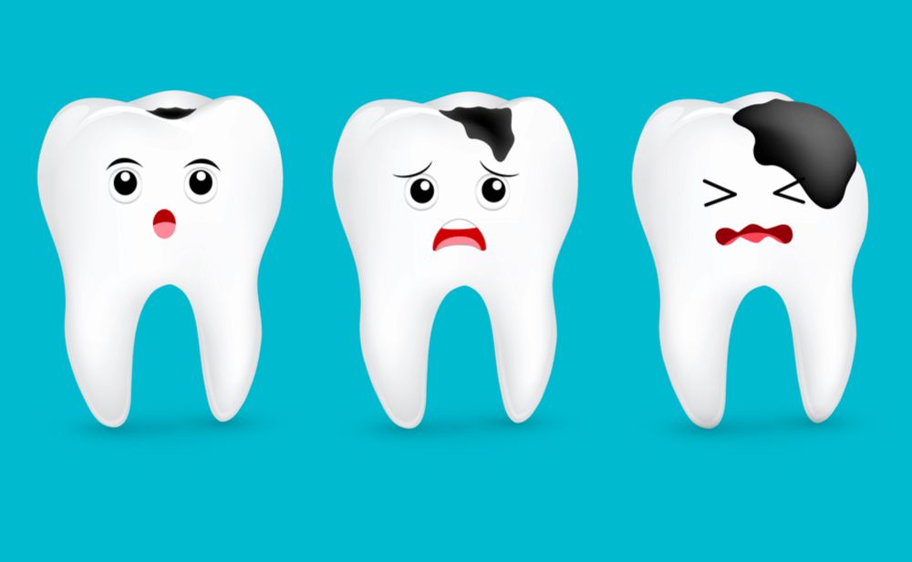 Sâu răng, cách phòng ngừa và điều trị sâu răng