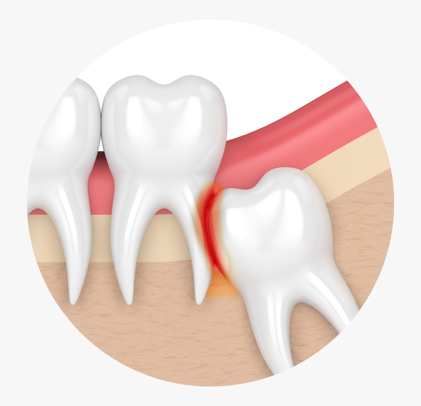 DẤU HIỆU BÁO BẠN SẮP CÓ RĂNG KHÔN