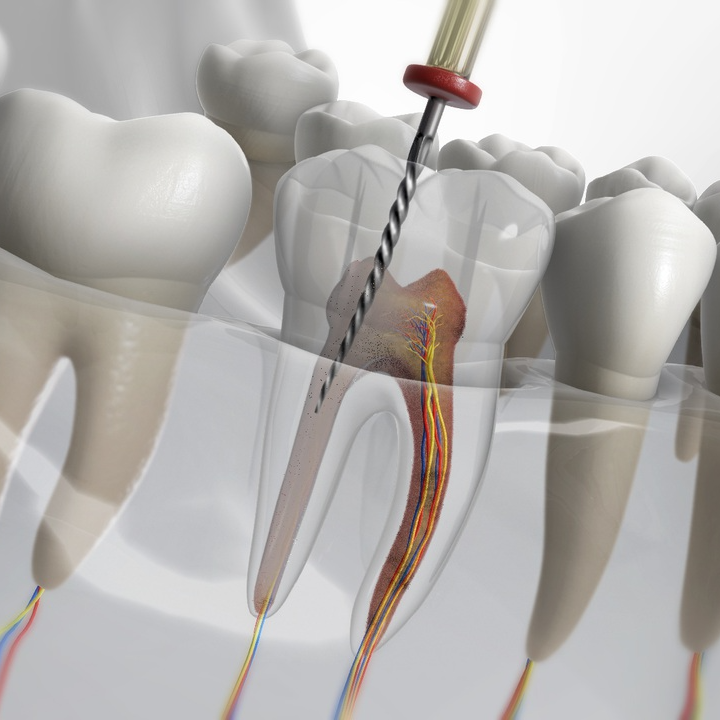 Vì sao răng chữa tủy thường hay thất bại và không giữ được lâu dài?