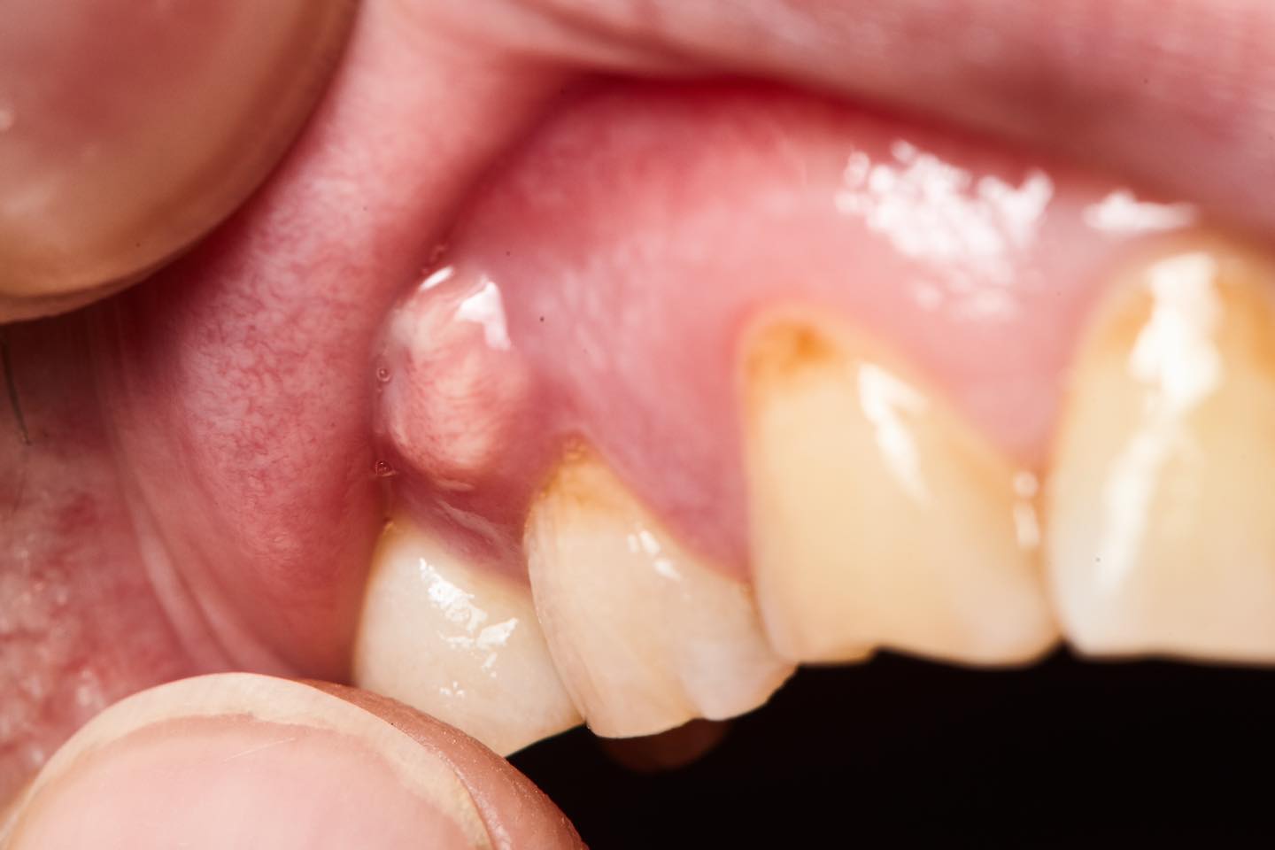 Làm gì khi răng bị nhiễm trùng, đau nhức?