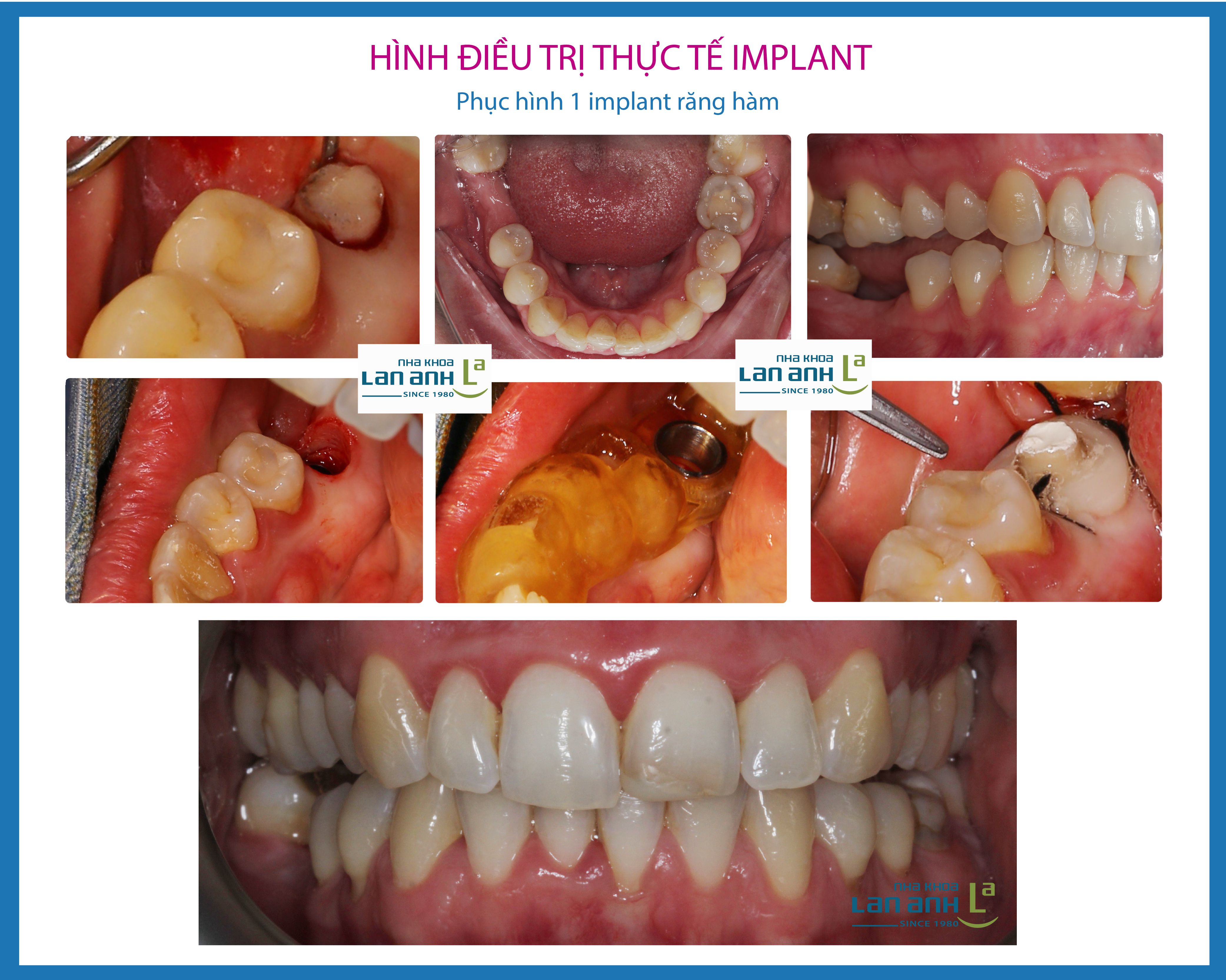 Cấy ghép Implant