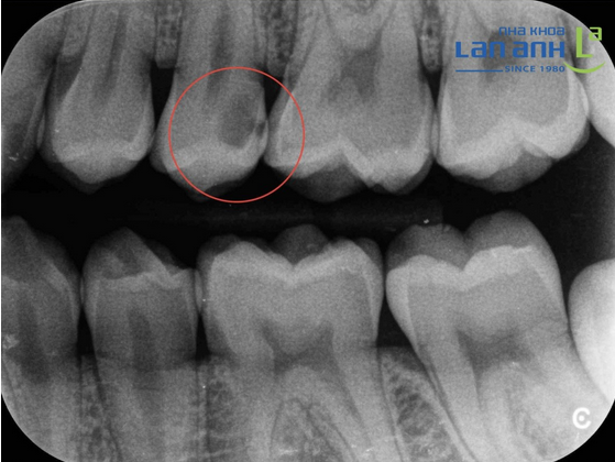 Sâu răng có dễ phát hiện được bằng mắt thường không?