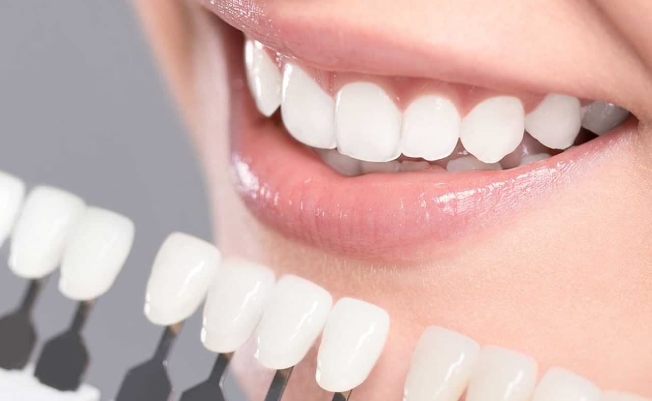 Vì sao tẩy trắng răng tại nha khoa lại hiệu quả hơn tự tẩy tại nhà?