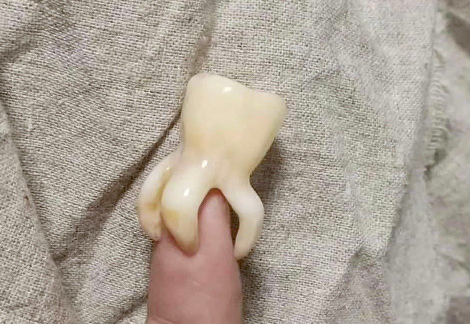 Độ khó của nhổ răng khôn phụ thuộc vào yếu tố nào?