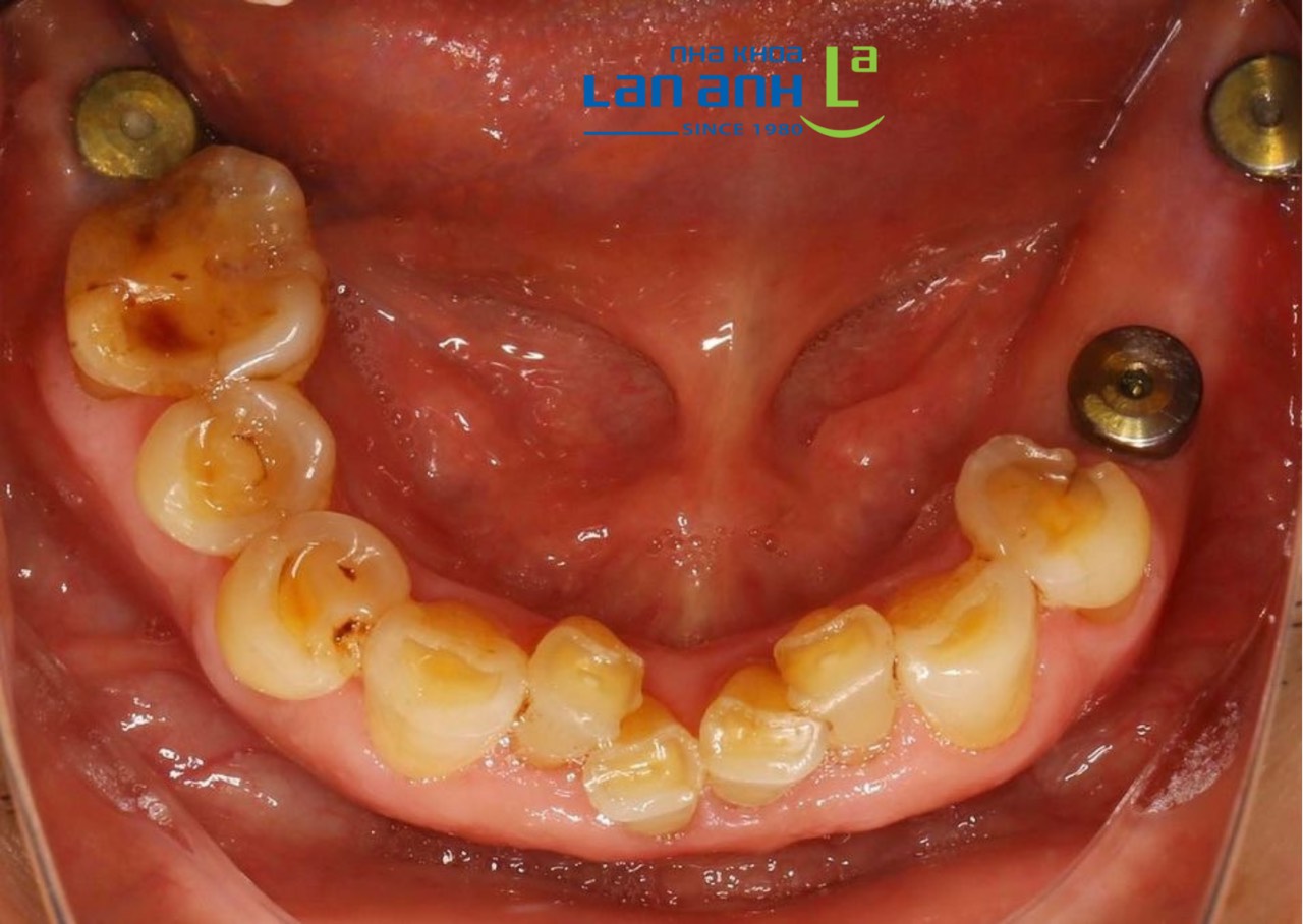 Thời điểm tốt nhất để lên kế hoạch trồng răng