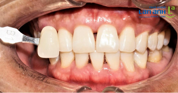 Tẩy trắng răng bằng hệ thống Zoom, đưa màu răng từ A3 lên màu B1 chỉ trong 60 phút