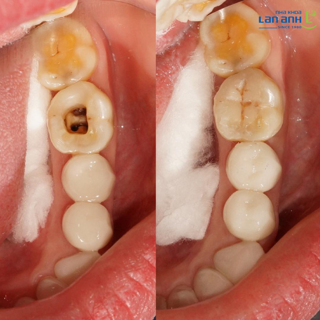 Khi nào thì răng chữa tủy có thể trám lại mà không cần bọc sứ?