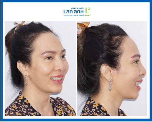 Câu hỏi thường gặp về niềng răng