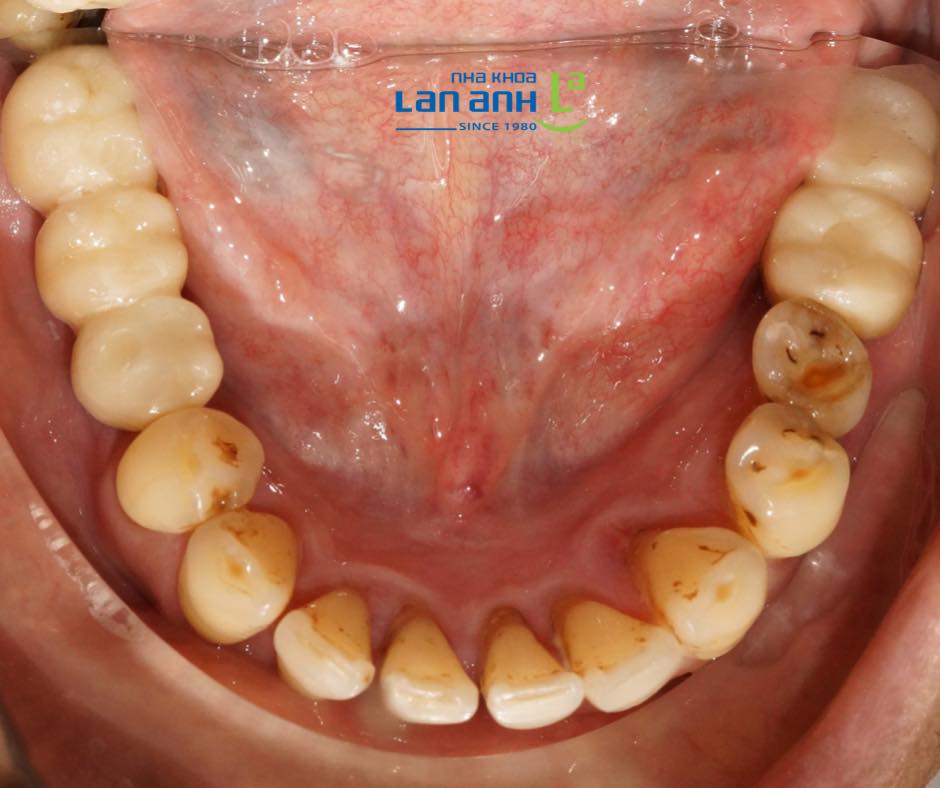 Giải pháp phù hợp khi mất răng nhiều