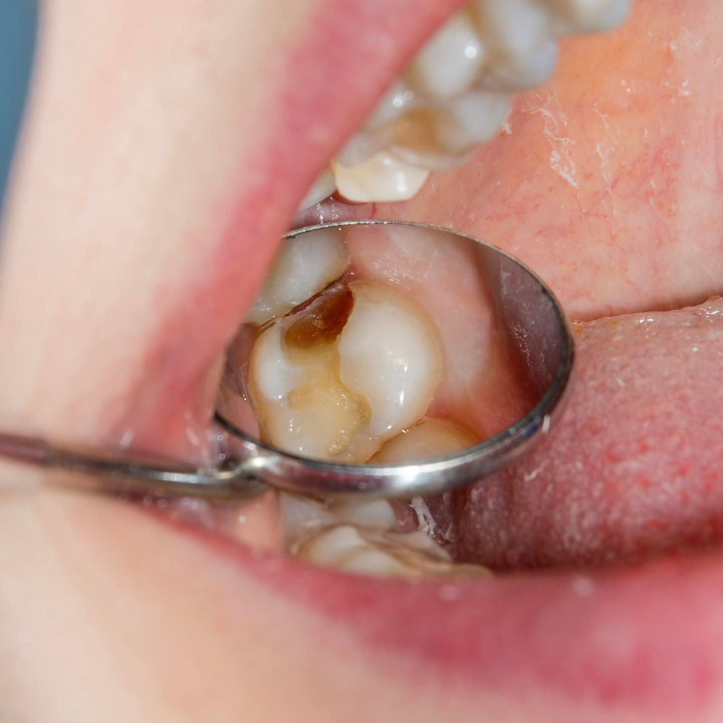 Khi nào răng bị sâu đến mức phải điều trị tủy răng?