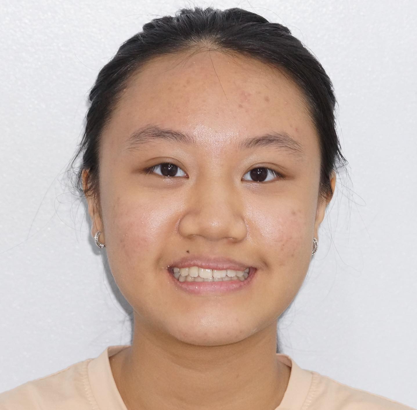 Niềng răng cho trẻ em cần đúng thời điểm phát triển