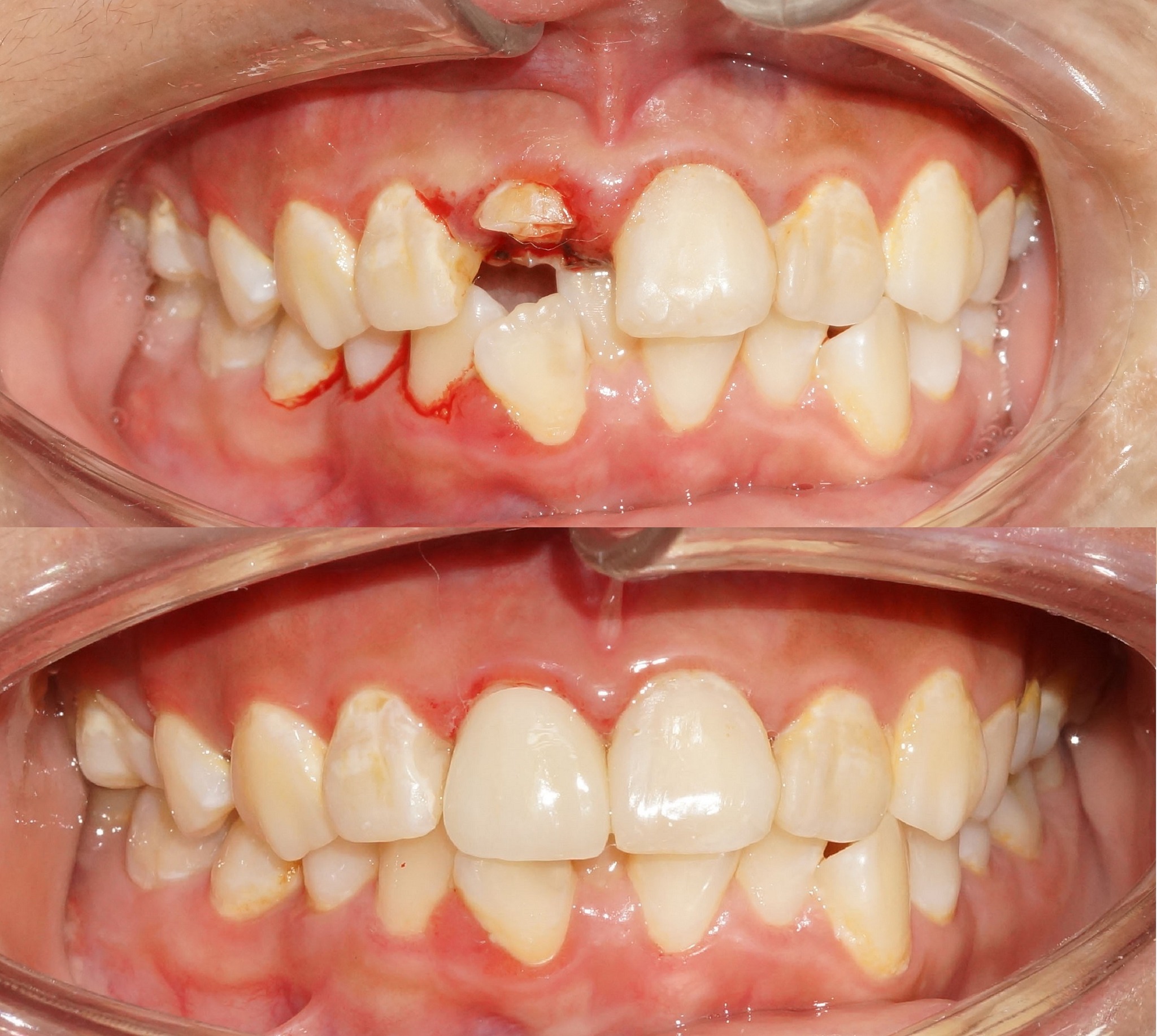 Phục hình răng thẩm mỹ cho răng cửa trẻ em