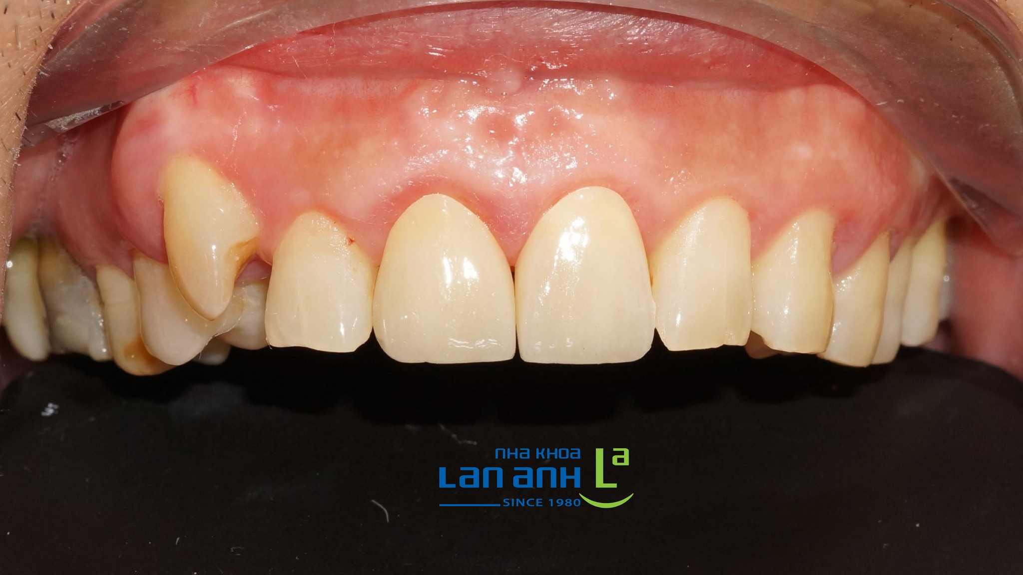 Răng sứ có thể làm giống y chang răng thật kế bên được không?