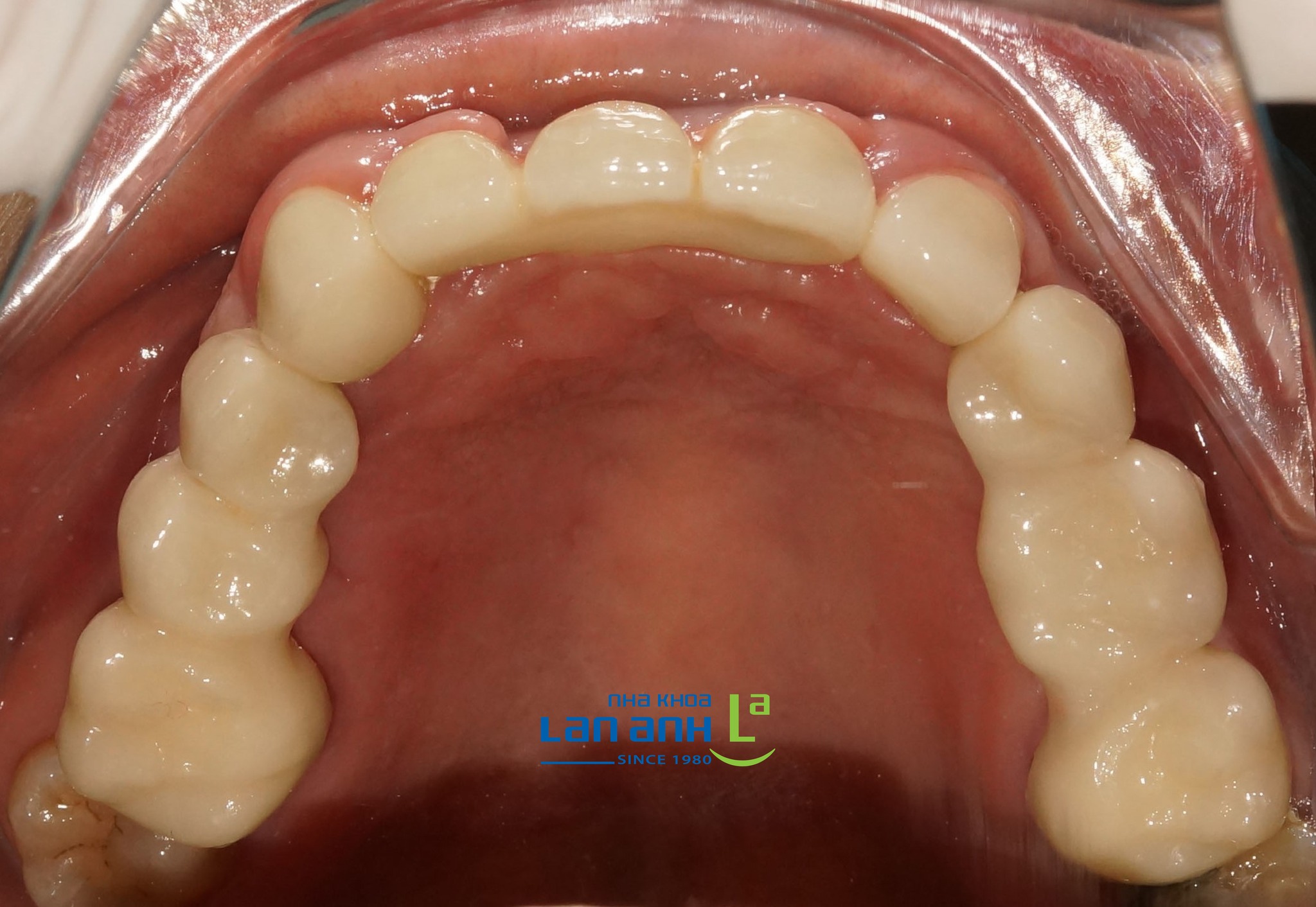 Thay hàm tháo lắp bằng Implant