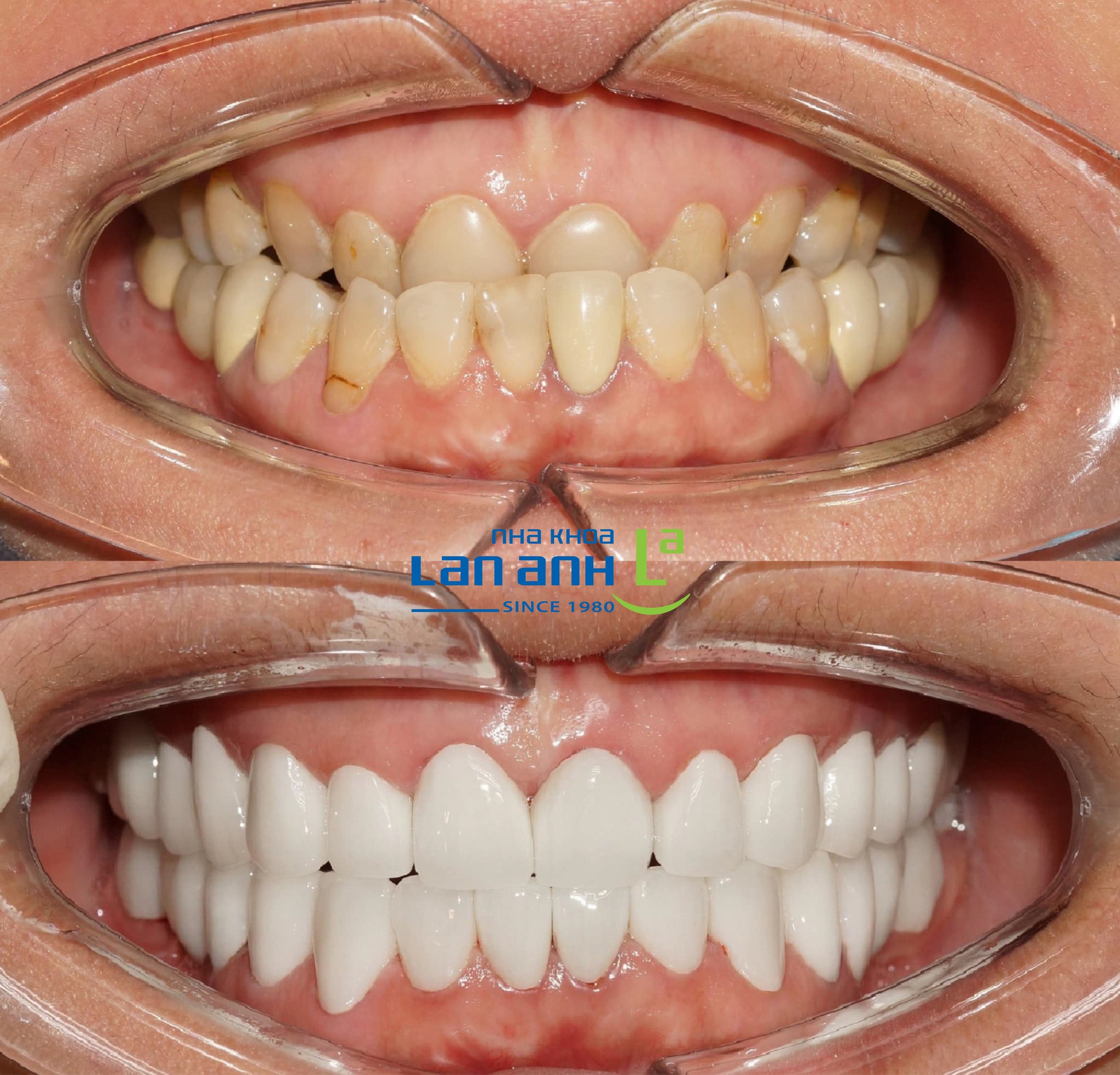Phục hình cho trường hợp khớp cắn ngược