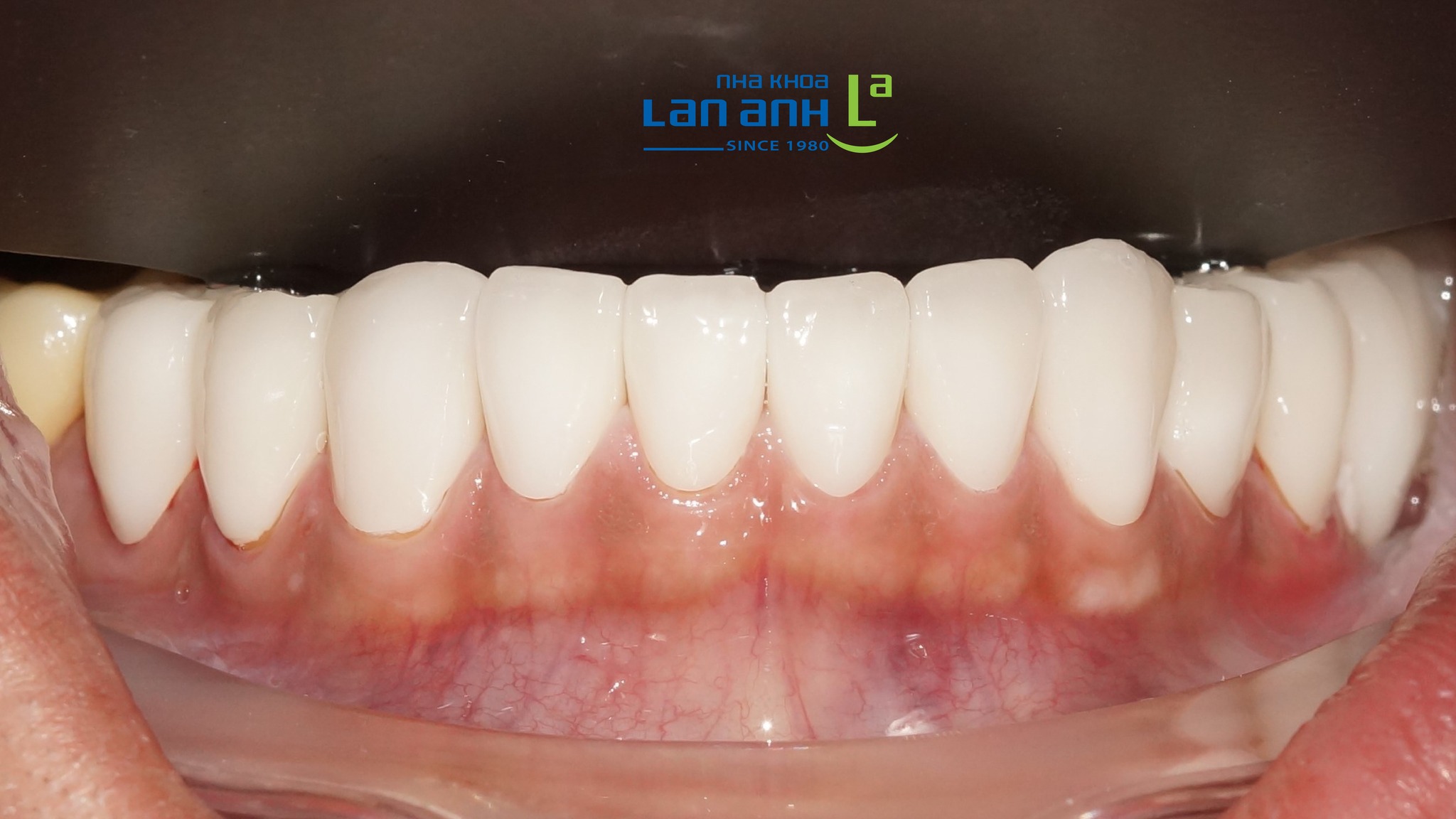 Làm răng sứ răng cửa dưới khó như thế nào?