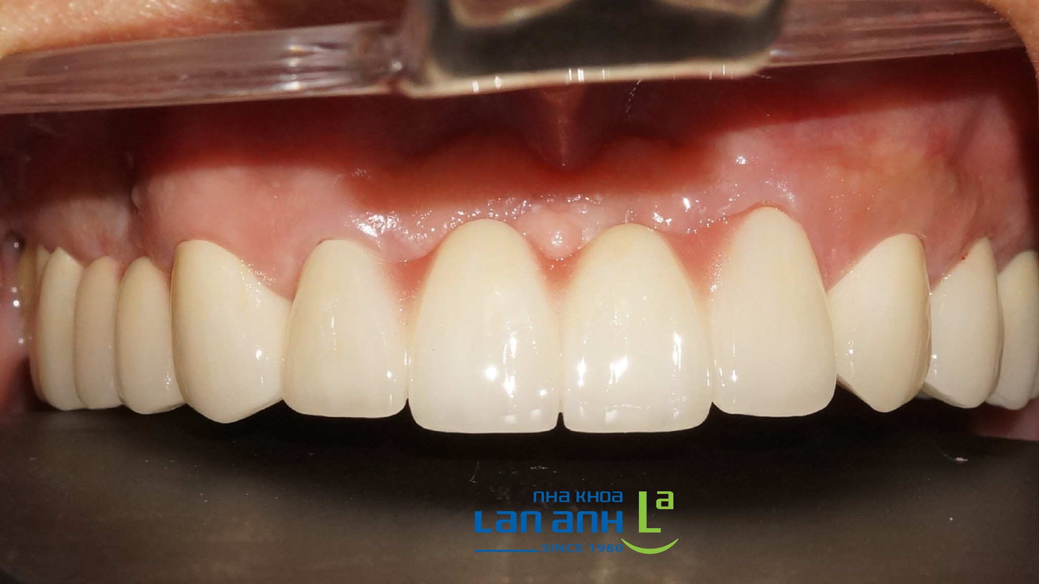 Răng sứ sau 10 năm sử dụng sẽ như thế nào?