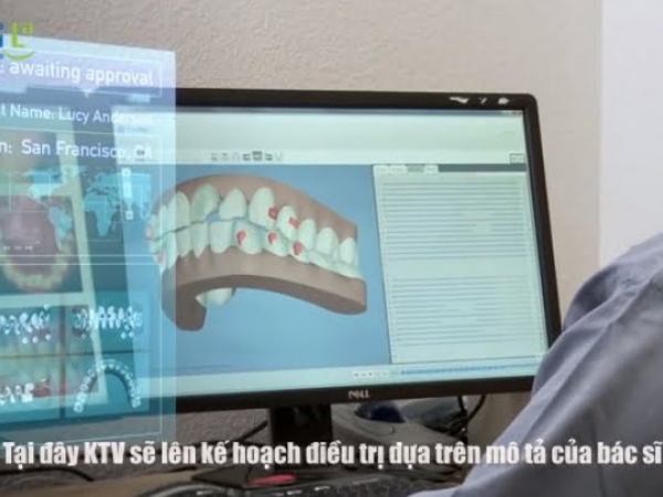 Chỉnh nha không mắc cài - chỉnh nha Invisalign 