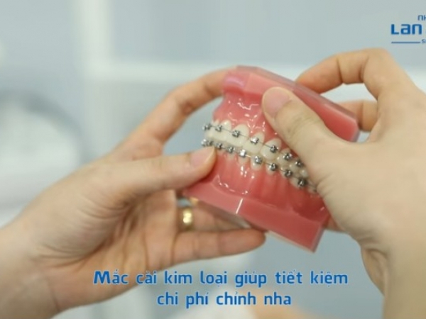 Chỉnh nha - Niềng răng tại Nha Khoa Lan Anh