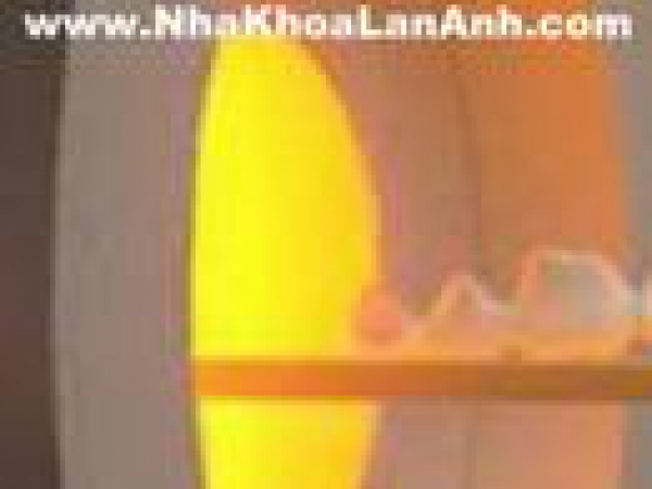 Clip - về hệ thống toàn sứ Zirconium - Cercon smart ceramic