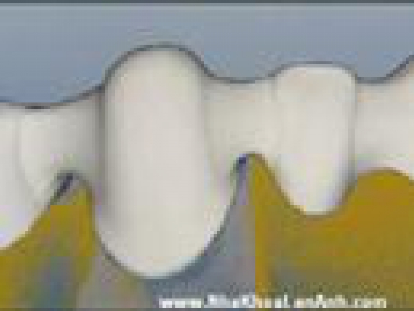 Clip - Qui trình làm răng toàn sứ CAD/CAM Zirconia (Emax ZirCAD, Cercon)
