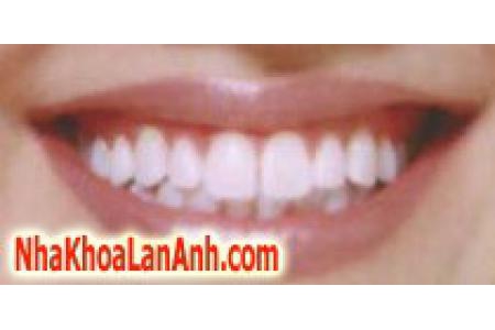 Tẩy trắng đối với răng sậm màu