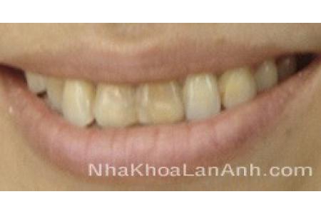 Răng sậm màu – Nguyên nhân và cách khắc phục