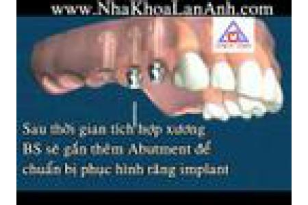 Clip – Quá trình cấy ghép răng implant