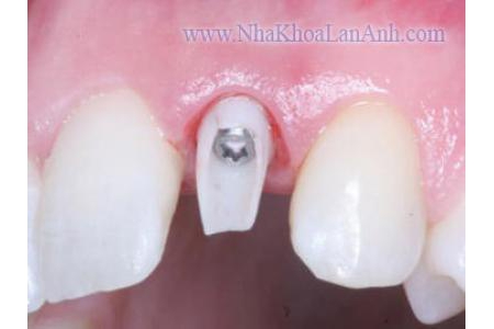 Implant trong trường hợp mất một răng