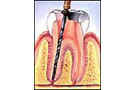 Hạn chế lấy tủy răng trong điều trị nha khoa