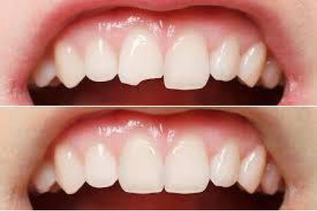 Răng sứ bị mẻ – Nguyên nhân, cách phòng ngừa và khắc phục.