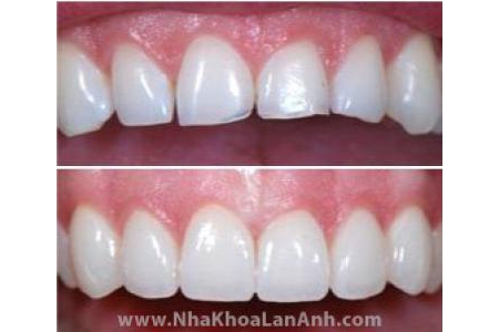 Đặc điểm phục hình răng sứ MCX5 và MCXL