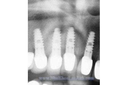 Implant trong trường hợp mất nhiều răng