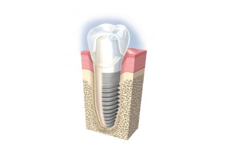 Implant là gì? Ưu điểm của Implant và đối tượng làm Implant