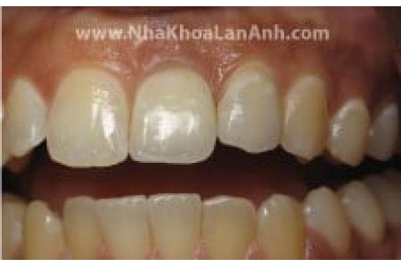 Những câu hỏi thường gặp khi cấy ghép Implant (phần 1)