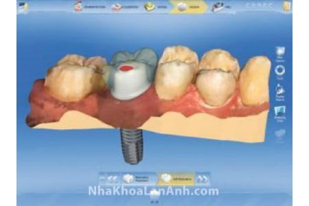 Những câu hỏi thường gặp khi cấy ghép Implant tại nha khoa Lan Anh (phần 2)
