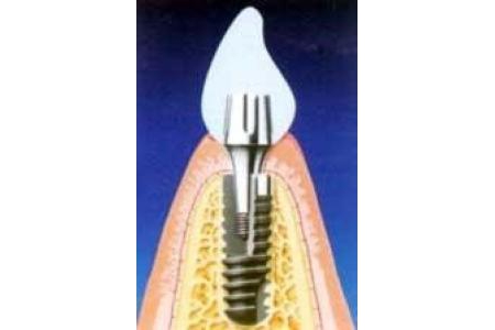 Cấy ghép Implant và phục hình răng sau 1 tuần (immediate loading implant)