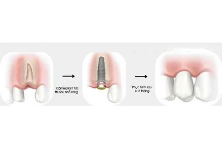 Thời điểm thích hợp cấy ghép implant